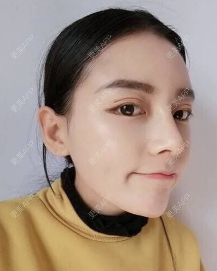 更美 - 妙药的埋线提升经验 | 埋线提升 | 南昌