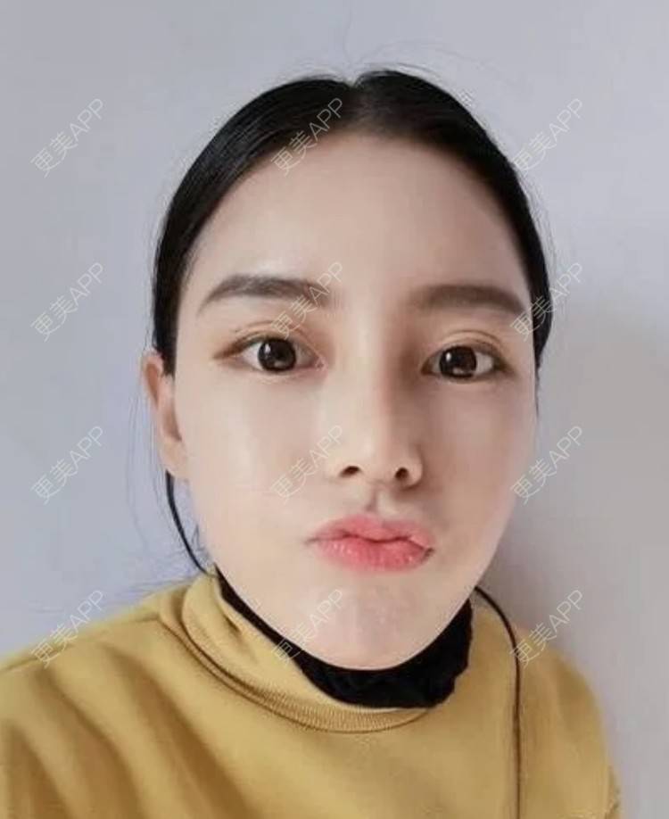 更美 - 妙药的埋线提升经验 | 埋线提升 | 南昌