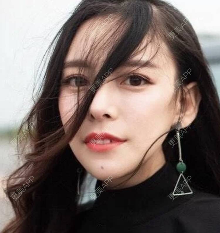 更美 - 妙药的埋线提升经验 | 埋线提升 | 南昌