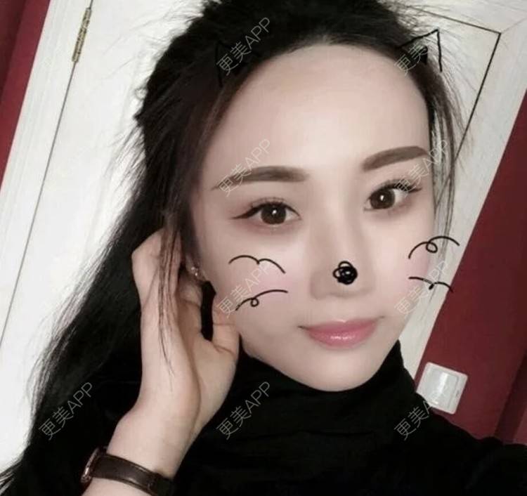 更美 - 爱思特直播小助理的埋线提升经验 | 埋线提升 | 南昌