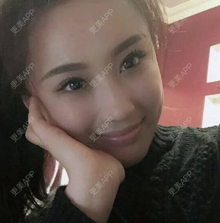 更美 - 爱思特直播小助理的埋线提升经验 | 埋线提升 | 南昌