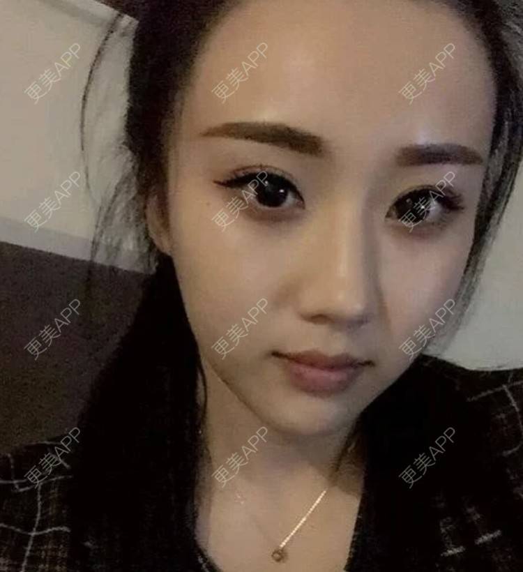 更美 - 爱思特直播小助理的埋线提升经验 | 埋线提升 | 南昌