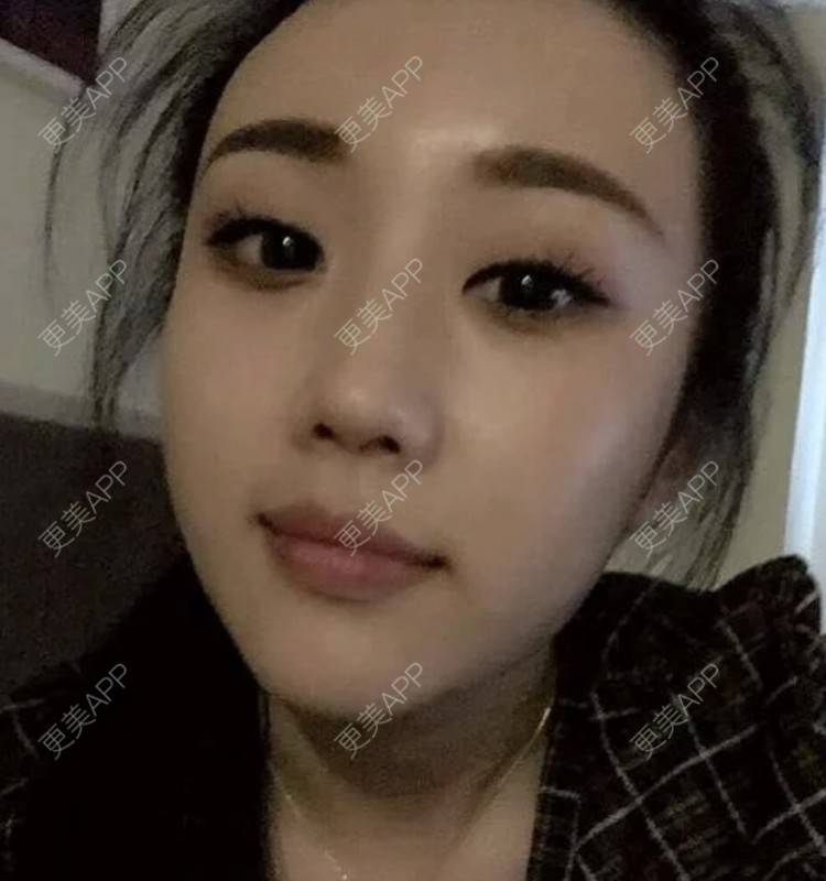 更美 - 爱思特直播小助理的埋线提升经验 | 埋线提升 | 南昌