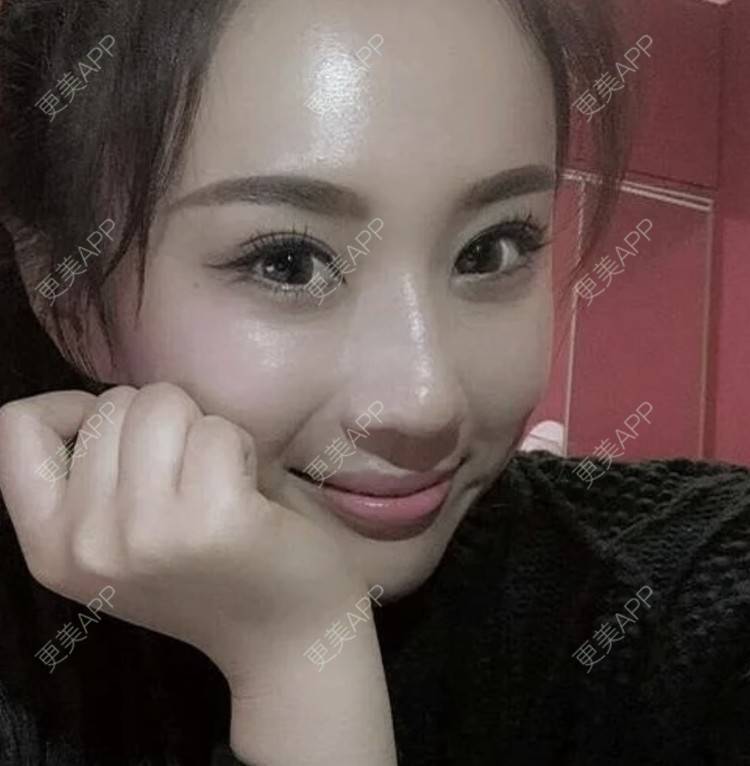 更美 - 爱思特直播小助理的埋线提升经验 | 埋线提升 | 南昌