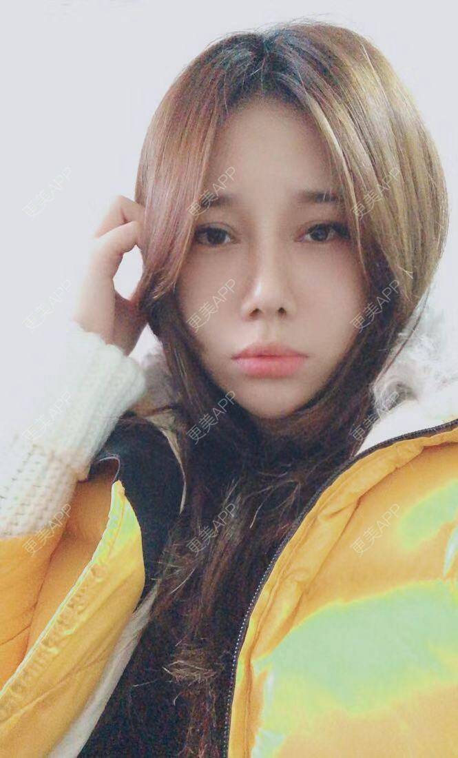 更美 - 娇滴滴的你的自体脂肪丰苹果肌经验 | 自体脂肪全面部填充 | 重庆 | 自体脂肪丰太阳穴 | 自体脂肪丰面颊 | 自体脂肪丰苹果肌 | 自体脂肪垫下巴