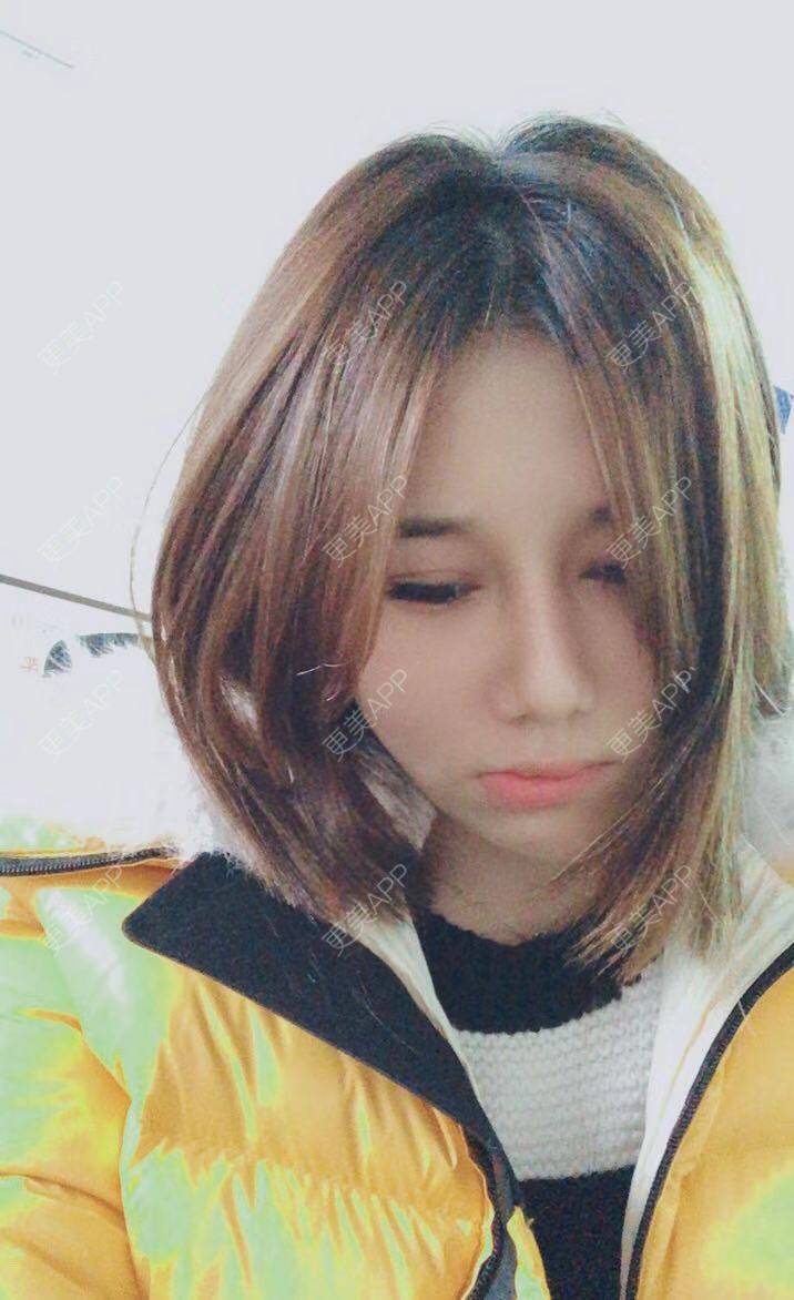 更美 - 娇滴滴的你的自体脂肪丰苹果肌经验 | 自体脂肪全面部填充 | 重庆 | 自体脂肪丰太阳穴 | 自体脂肪丰面颊 | 自体脂肪丰苹果肌 | 自体脂肪垫下巴