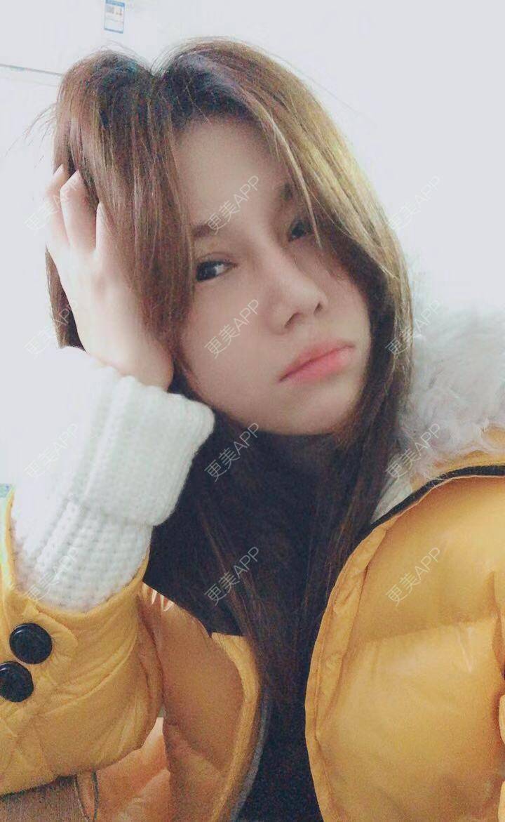 更美 - 娇滴滴的你的自体脂肪丰苹果肌经验 | 自体脂肪全面部填充 | 重庆 | 自体脂肪丰太阳穴 | 自体脂肪丰面颊 | 自体脂肪丰苹果肌 | 自体脂肪垫下巴