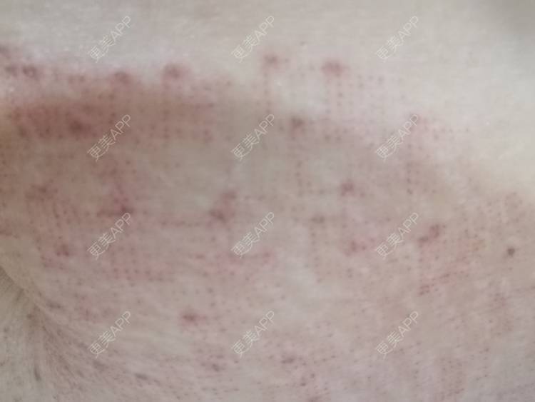 更美 - 艾米妈妈！的微针淡化妊娠纹经验 | 秦皇岛 | 微针淡化妊娠纹