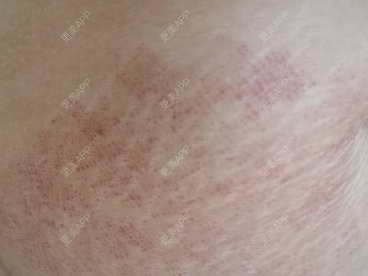 更美 - 艾米妈妈！的微针淡化妊娠纹经验 | 秦皇岛 | 微针淡化妊娠纹