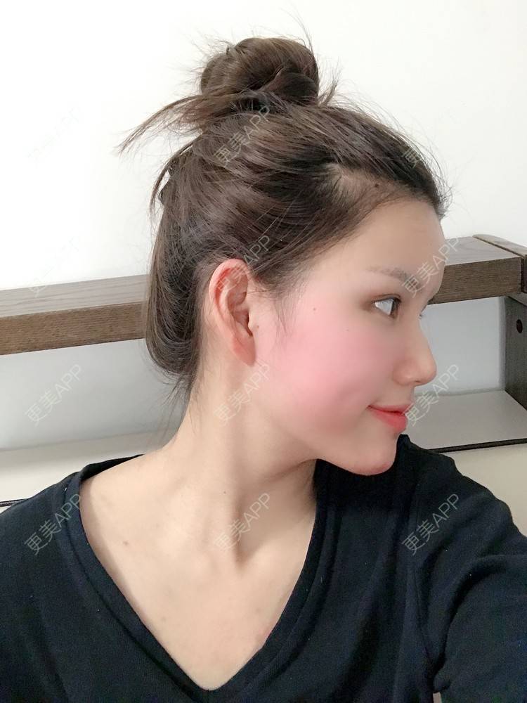 更美 - Lilya果儿的自体脂肪全面部填充经验 | 广州 | 自体脂肪全面部填充