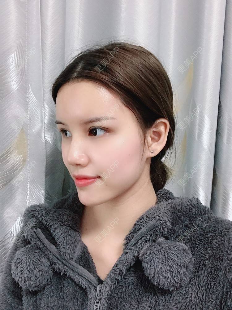 更美 - Lilya果儿的自体脂肪全面部填充经验 | 广州 | 自体脂肪全面部填充