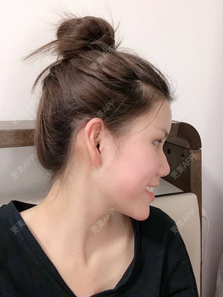 更美 - Lilya果儿的自体脂肪全面部填充经验 | 广州 | 自体脂肪全面部填充