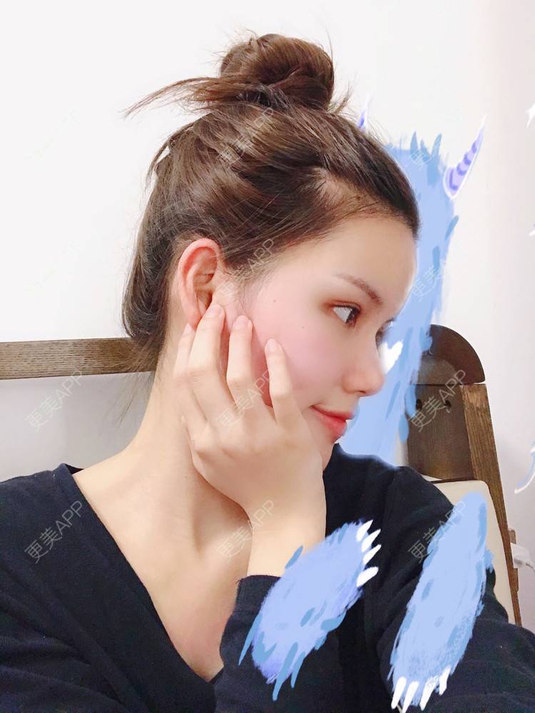 更美 - Lilya果儿的自体脂肪全面部填充经验 | 广州 | 自体脂肪全面部填充