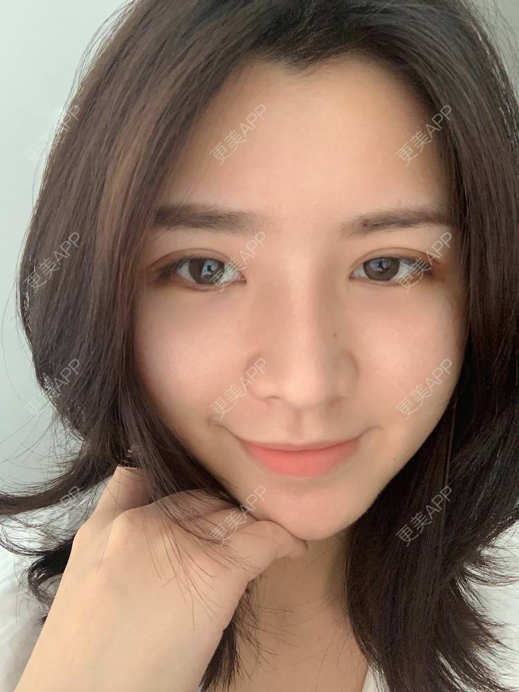 更美 - 更美用户B670A6hUBe的眼部综合经验 | 广州 | 眼部综合
