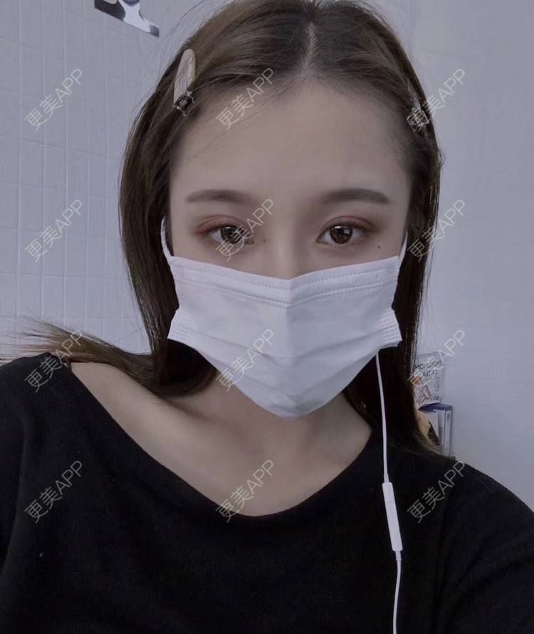 更美 - 更美用户QvbGN4TwBz的耳软骨隆鼻经验 | 耳软骨隆鼻 | 视频日记 | 佛山