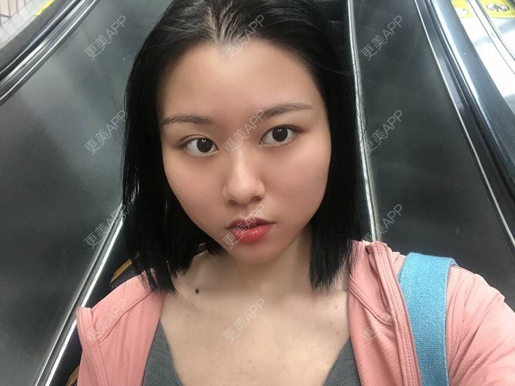 更美 - 玉子燒、的激光脱发际线经验 | 激光脱发际线 | 广州 | 大腿脱毛