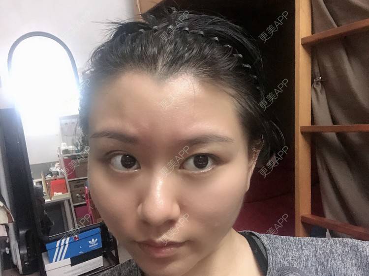 更美 - 玉子燒、的激光脱发际线经验 | 激光脱发际线 | 广州 | 大腿脱毛