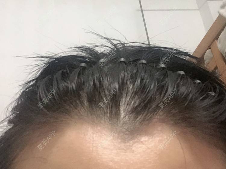 更美 - 玉子燒、的激光脱发际线经验 | 激光脱发际线 | 广州 | 大腿脱毛