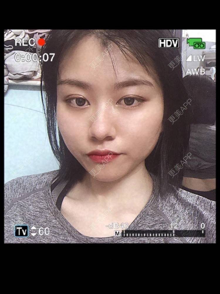 更美 - 玉子燒、的激光脱发际线经验 | 激光脱发际线 | 广州 | 大腿脱毛
