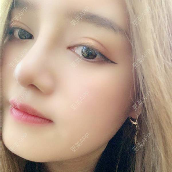 去皮去脂翘睫郑州￥3980起【全切双眼皮】【切开双眼皮】小清新双眼皮