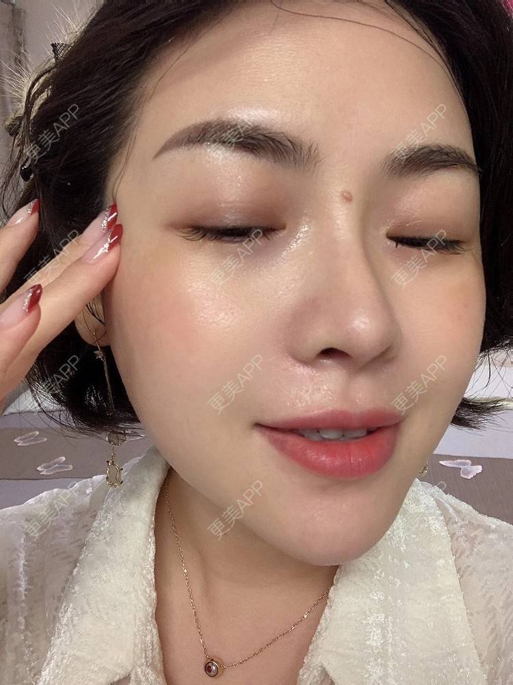 更美 - 小陀螺11的隆鼻经验 | 隆鼻 | 赤峰