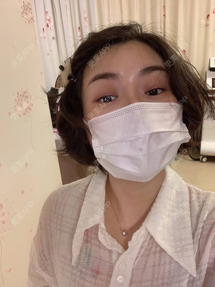 更美 - 小陀螺11的隆鼻经验 | 隆鼻 | 赤峰