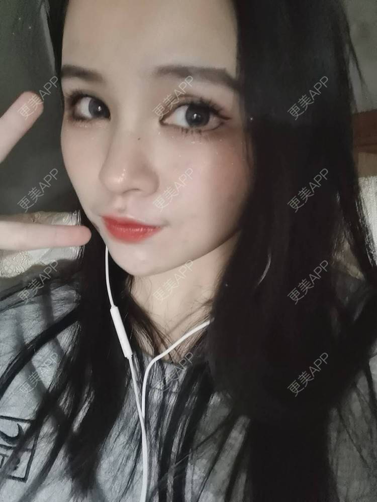 更美 - 耿直girl在线的鼻部多项经验 | 耳软骨隆鼻 | 肋软骨隆鼻 | 鼻小柱延长 | 鼻部多项 | 自体软骨垫鼻尖 | 膨体隆鼻 | 鼻中隔软骨垫鼻头 | 鼻中隔软骨隆鼻 | 垫鼻尖 | 人工骨隆鼻