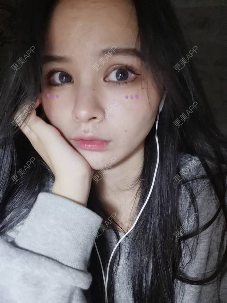 更美 - 耿直girl在线的鼻部多项经验 | 耳软骨隆鼻 | 肋软骨隆鼻 | 鼻小柱延长 | 鼻部多项 | 自体软骨垫鼻尖 | 膨体隆鼻 | 鼻中隔软骨垫鼻头 | 鼻中隔软骨隆鼻 | 垫鼻尖 | 人工骨隆鼻