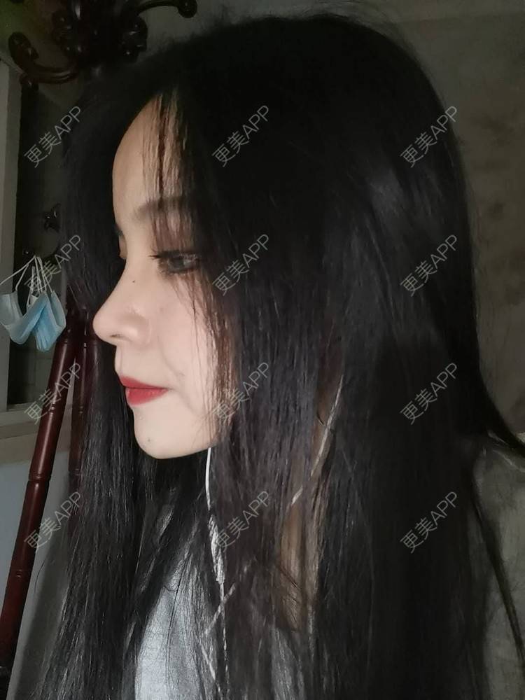 更美 - 耿直girl在线的鼻部多项经验 | 耳软骨隆鼻 | 肋软骨隆鼻 | 鼻小柱延长 | 鼻部多项 | 自体软骨垫鼻尖 | 膨体隆鼻 | 鼻中隔软骨垫鼻头 | 鼻中隔软骨隆鼻 | 垫鼻尖 | 人工骨隆鼻