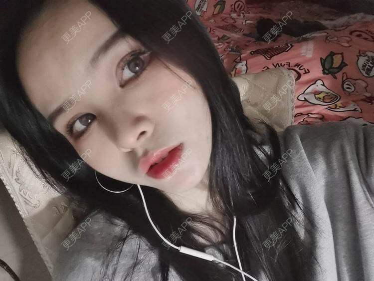 更美 - 耿直girl在线的鼻部多项经验 | 耳软骨隆鼻 | 肋软骨隆鼻 | 鼻小柱延长 | 鼻部多项 | 自体软骨垫鼻尖 | 膨体隆鼻 | 鼻中隔软骨垫鼻头 | 鼻中隔软骨隆鼻 | 垫鼻尖 | 人工骨隆鼻