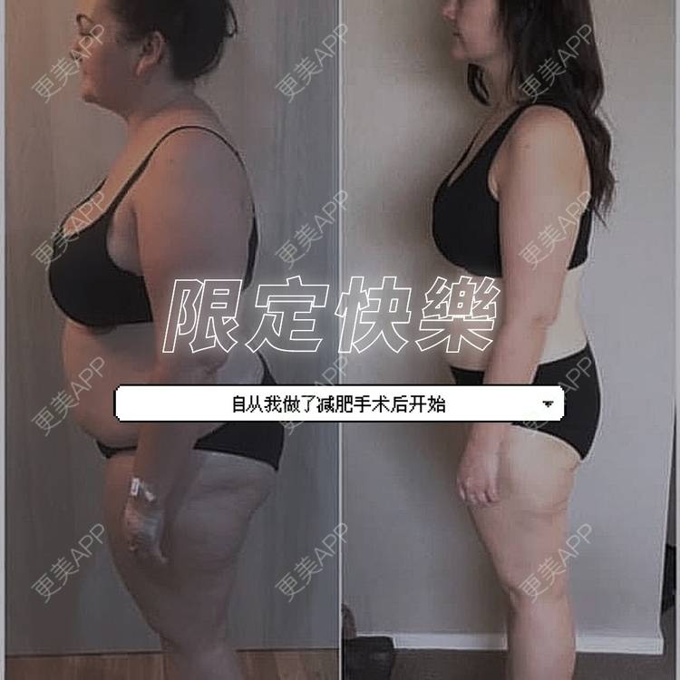 更美 - Thai幸运了泰医美的超声溶脂瘦腹部经验 | 吸脂 | 腰部吸脂 | 超声溶脂瘦腹部 | 超声溶脂瘦大腿 | 曼谷