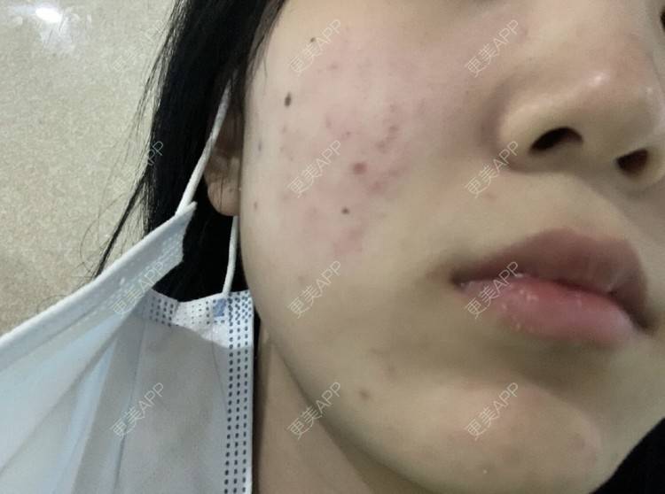 更美 - 阿妮Co的红蓝光清痘经验 | 针清清痘 | 果酸焕肤 | 红蓝光清痘