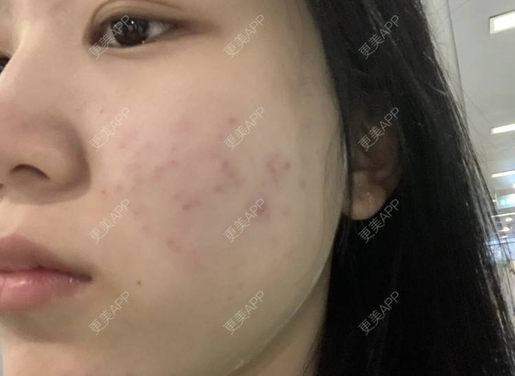 更美 - 阿妮Co的红蓝光清痘经验 | 针清清痘 | 果酸焕肤 | 红蓝光清痘