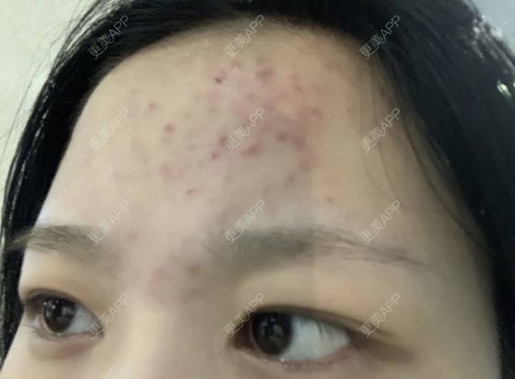 更美 - 阿妮Co的红蓝光清痘经验 | 针清清痘 | 果酸焕肤 | 红蓝光清痘