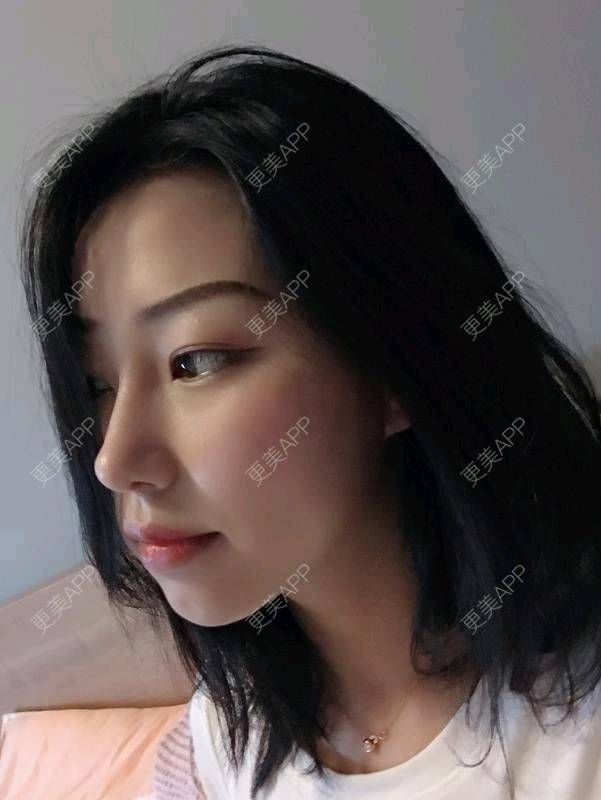 更美 - 更美用户agGHM0OZL2的隆鼻经验 | 隆鼻 | 武汉