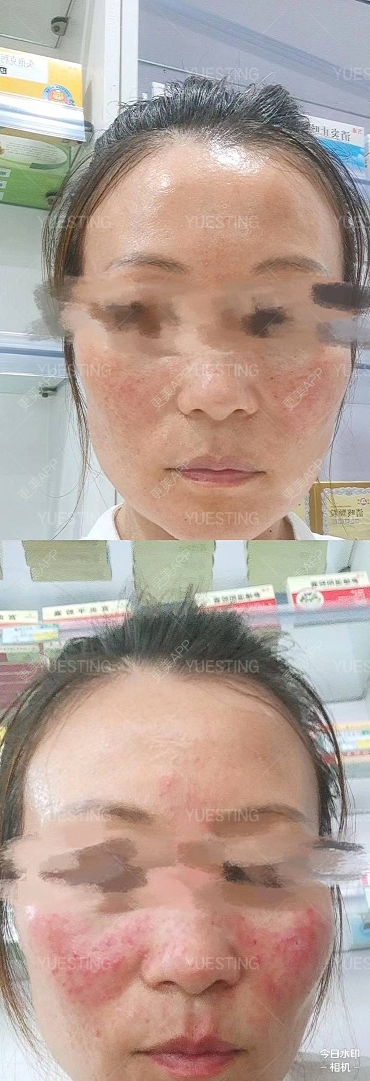 更美 - 悦丝汀，修复敏感肌的微针水光经验 | 舒敏之星 | 微针水光 | 成都