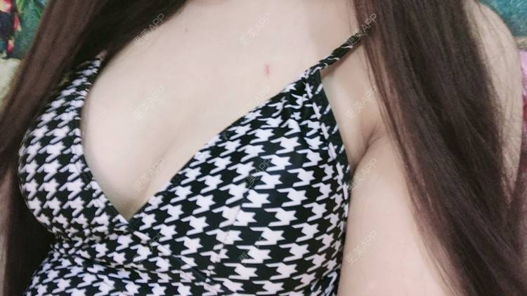 更美 - 晴天baby的假体隆胸经验 | 假体隆胸 | 郑州