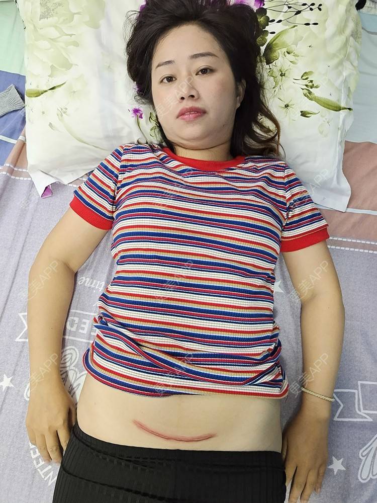 更美 - 更美用户I9LQn2M8I0的激光淡疤经验 | 剖腹产手术 | 激光淡疤 | 祛疤痕痘印 | 成都
