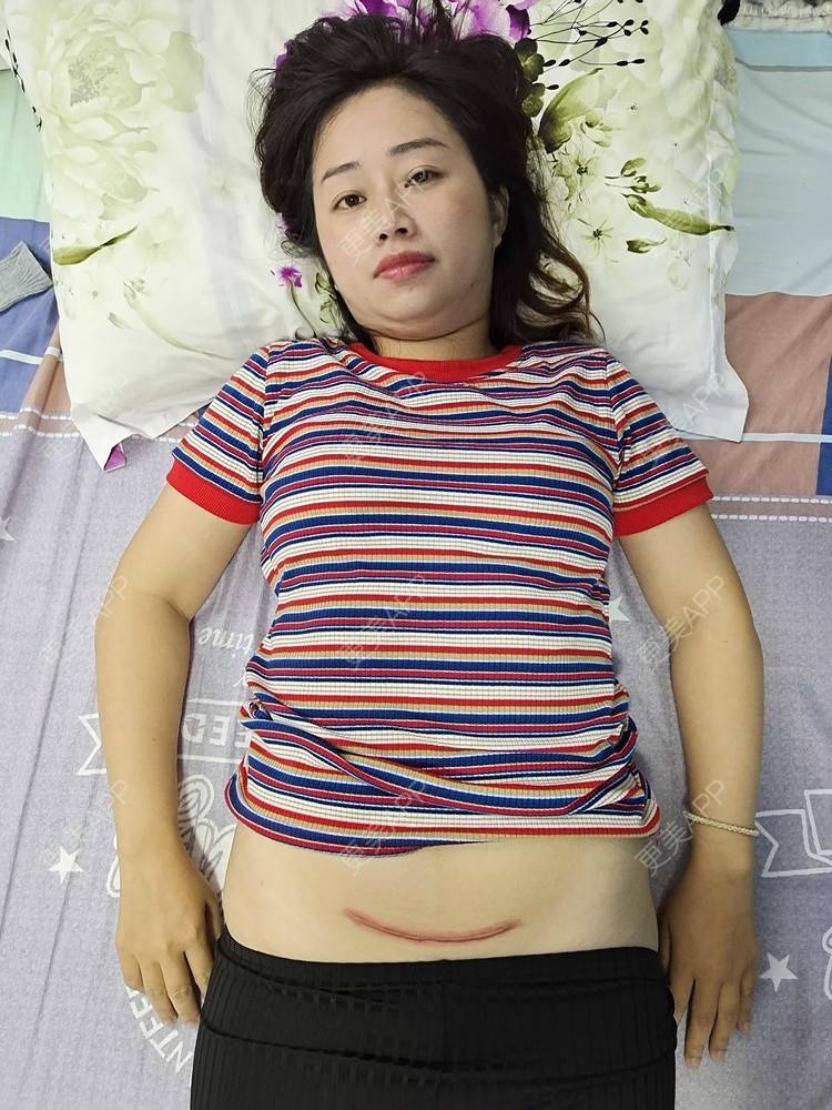 更美 - 更美用户I9LQn2M8I0的激光淡疤经验 | 剖腹产手术 | 激光淡疤 | 祛疤痕痘印 | 成都