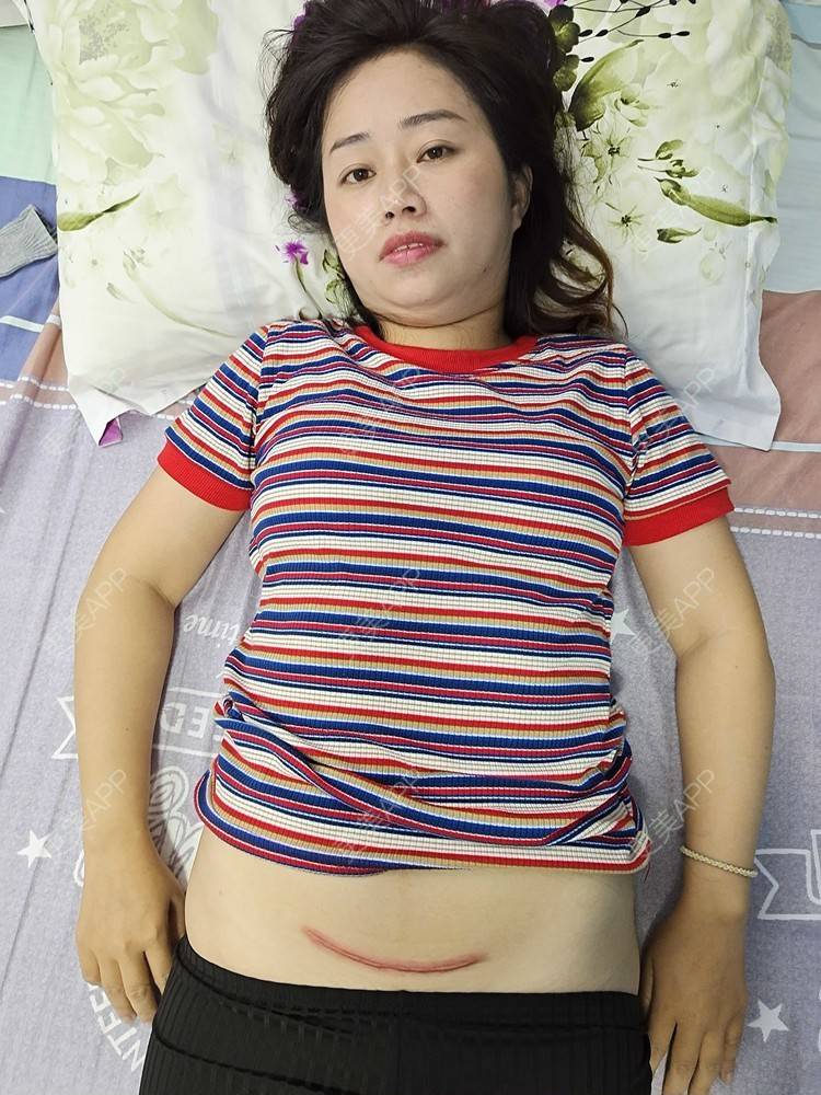 更美 - 更美用户I9LQn2M8I0的激光淡疤经验 | 剖腹产手术 | 激光淡疤 | 祛疤痕痘印 | 成都