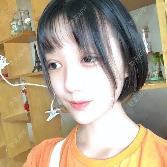 更美 - 更美用户QhVYqz6e5S的双眼皮经验 | 上海 | 双眼皮