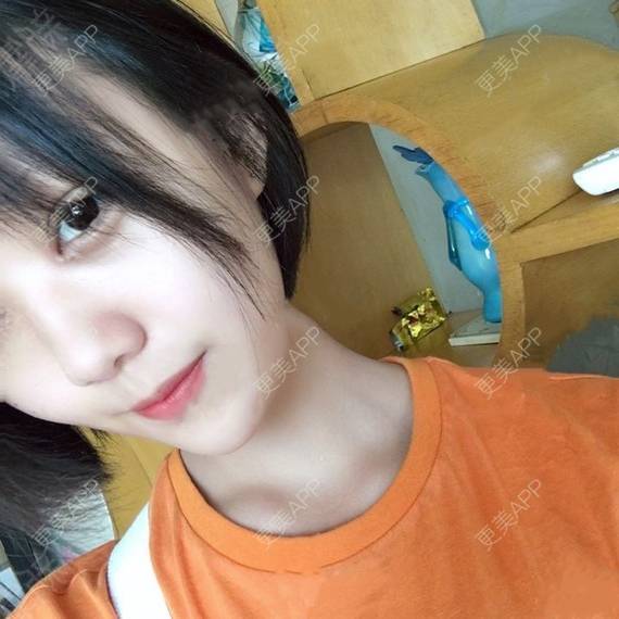 更美 - 更美用户QhVYqz6e5S的双眼皮经验 | 上海 | 双眼皮