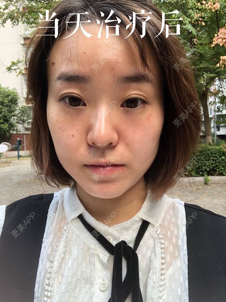 更美 - 田小雕的热玛吉经验 | 热玛吉 | 宁波