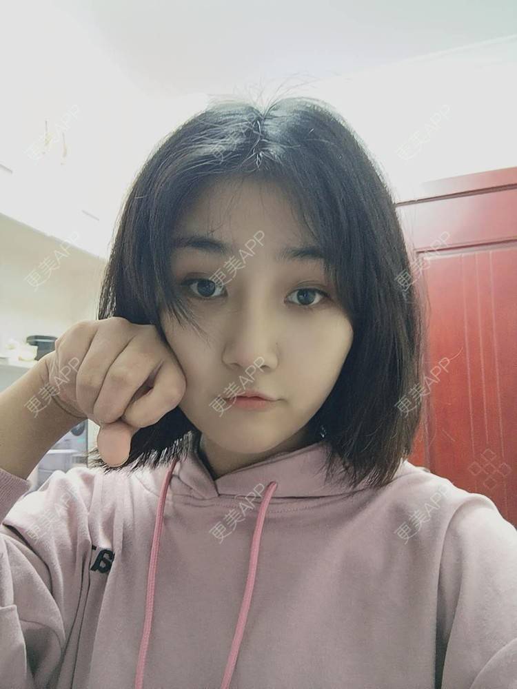 更美 - 更美用户6lAitmtq7D的自体脂肪填充泪沟经验 | 自体脂肪丰苹果肌 | 自体脂肪面部填充 | 自体脂肪垫鼻基底 | 自体脂肪全面部填充 | 自体脂肪填充法令纹 | 自体脂肪填充泪沟 | 自体脂肪垫下巴 | 自体脂肪丰面颊 | 自体脂肪丰太阳穴 | 自体脂肪丰额头 | 重庆 | 自体脂肪丰卧蚕