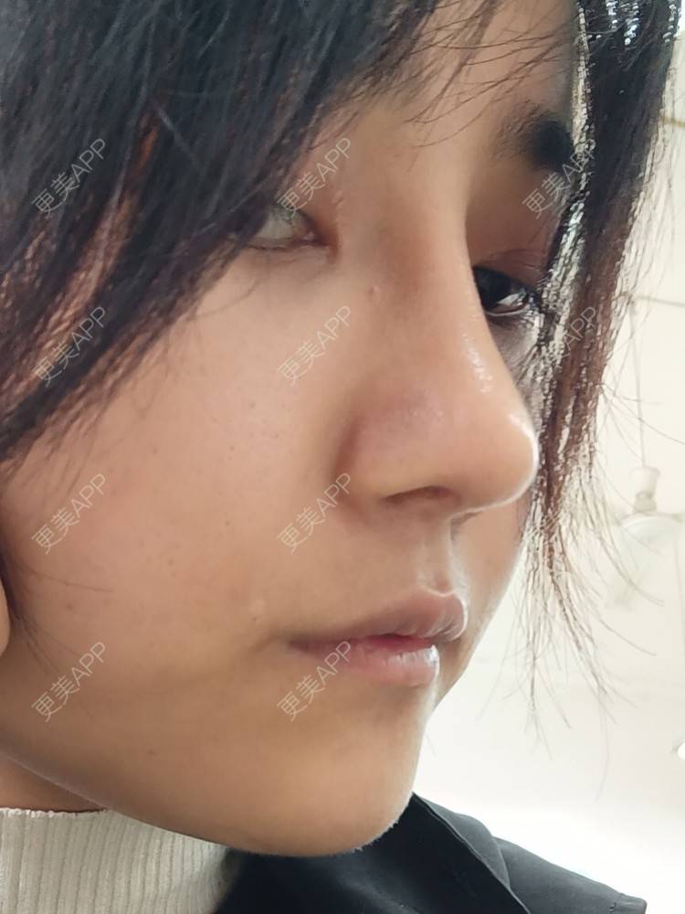 更美 - 更美用户6lAitmtq7D的自体脂肪填充泪沟经验 | 自体脂肪丰苹果肌 | 自体脂肪面部填充 | 自体脂肪垫鼻基底 | 自体脂肪全面部填充 | 自体脂肪填充法令纹 | 自体脂肪填充泪沟 | 自体脂肪垫下巴 | 自体脂肪丰面颊 | 自体脂肪丰太阳穴 | 自体脂肪丰额头 | 重庆 | 自体脂肪丰卧蚕
