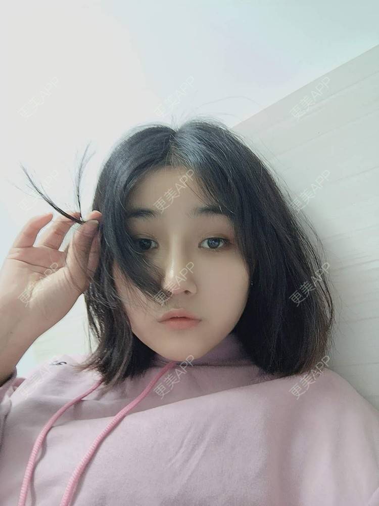 更美 - 更美用户6lAitmtq7D的自体脂肪填充泪沟经验 | 自体脂肪丰苹果肌 | 自体脂肪面部填充 | 自体脂肪垫鼻基底 | 自体脂肪全面部填充 | 自体脂肪填充法令纹 | 自体脂肪填充泪沟 | 自体脂肪垫下巴 | 自体脂肪丰面颊 | 自体脂肪丰太阳穴 | 自体脂肪丰额头 | 重庆 | 自体脂肪丰卧蚕