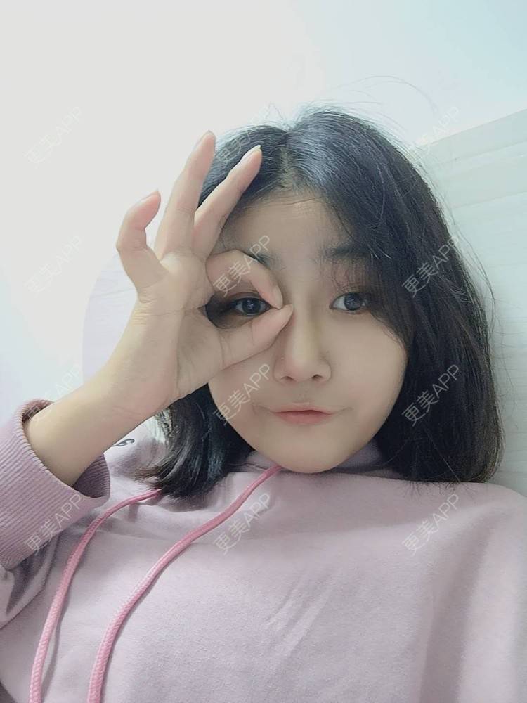更美 - 更美用户6lAitmtq7D的自体脂肪填充泪沟经验 | 自体脂肪丰苹果肌 | 自体脂肪面部填充 | 自体脂肪垫鼻基底 | 自体脂肪全面部填充 | 自体脂肪填充法令纹 | 自体脂肪填充泪沟 | 自体脂肪垫下巴 | 自体脂肪丰面颊 | 自体脂肪丰太阳穴 | 自体脂肪丰额头 | 重庆 | 自体脂肪丰卧蚕
