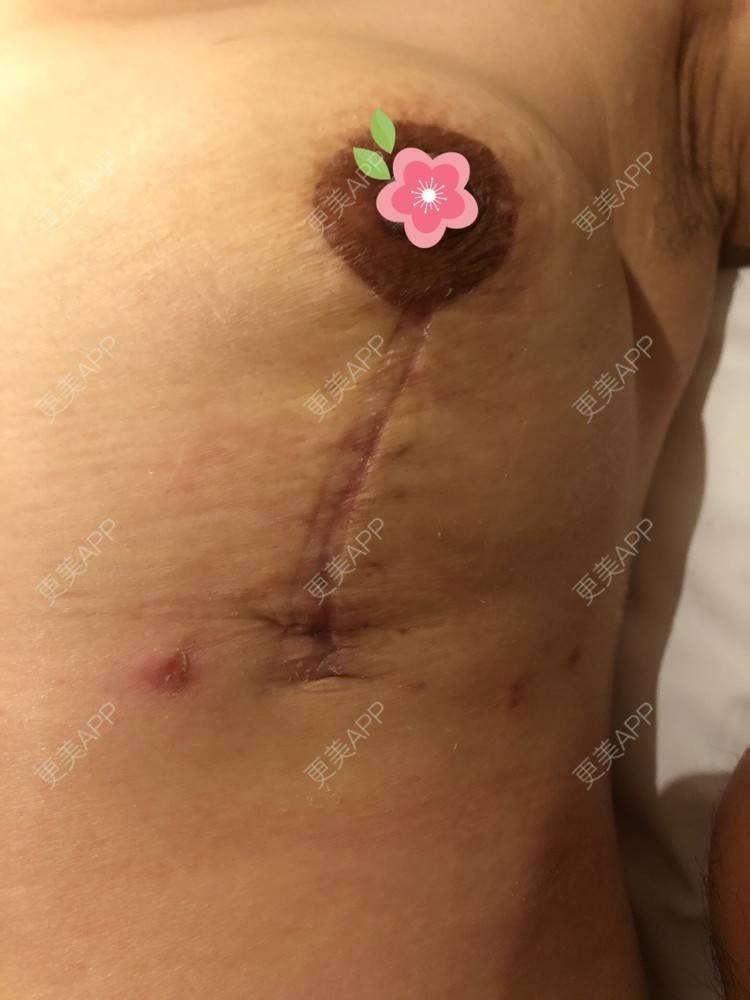更美 - 更美用户ZN5LsrY6bk的乳晕缩小经验 | 乳晕缩小 | 缩胸手术 | 胸部下垂矫正 | 杭州