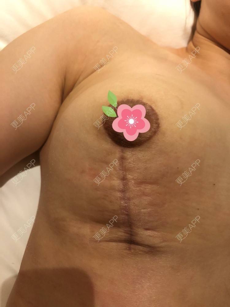 更美 - 更美用户ZN5LsrY6bk的乳晕缩小经验 | 乳晕缩小 | 缩胸手术 | 胸部下垂矫正 | 杭州