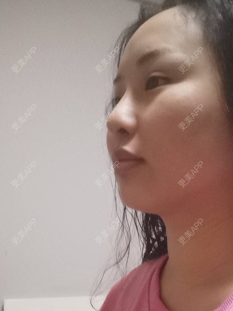 更美 - 沉沉mm的吸脂瘦脸经验 | 轮廓修复术 | 全脸整形套餐 | V脸套餐 | 激光溶脂瘦脸 | 射频溶脂瘦脸 | 吸脂瘦脸 | 自体脂肪丰面颊 | 吸脂 | 背部吸脂 | 手臂吸脂 | 玻尿酸面颊 | 胶原蛋白丰面颊 | 面部不对称矫正